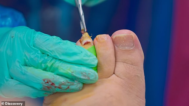 As Marion began the treatment, she took out the needle to numb Craig's toes before removing the nails from the nail bed.