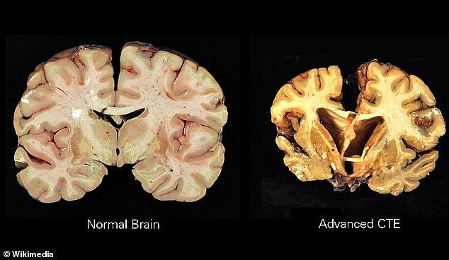 A brain with advanced CTE (pictured right) appears shriveled. As tau proteins build up and brain cells die, the brain volume decreases and it shrinks.
