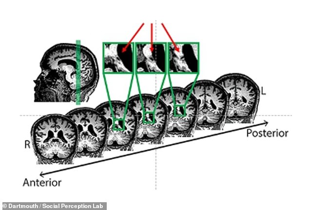 The damage that led to PMO often appeared as lesions on the occipital and temporal lobes at the back of the brain, near areas that neuroscientists have classified as face recognition areas, marked in green above . But some mysterious cases are more difficult to trace