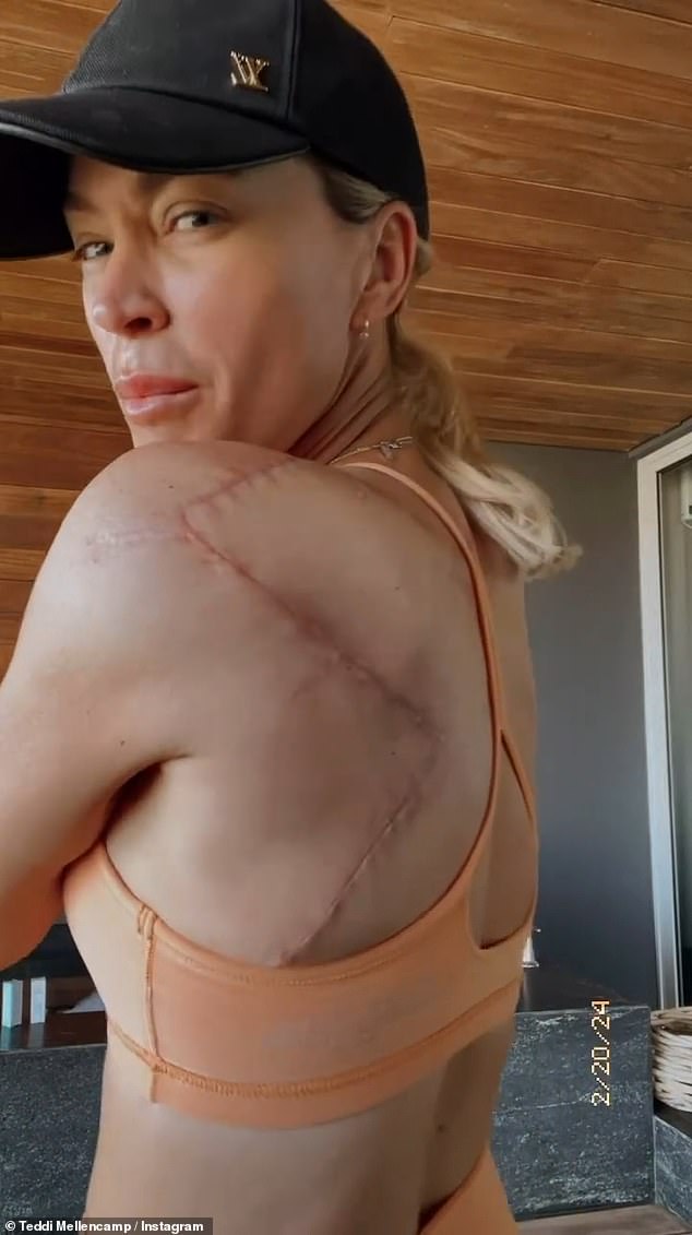The 'Real Housewives of Beverly Hills' star, 42, revealed last October that she had been diagnosed with stage 2 of the disease and underwent surgery in December to remove melanoma from her back ¿ but she has now revealed her team after examining another suspicious patch on her arm