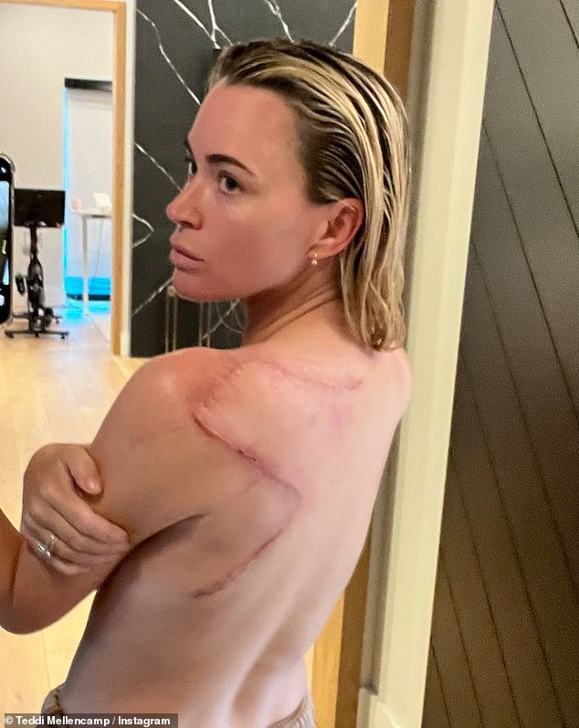 Teddi urged her fans to get their skin checked out so they can avoid the kind of surgery she had
