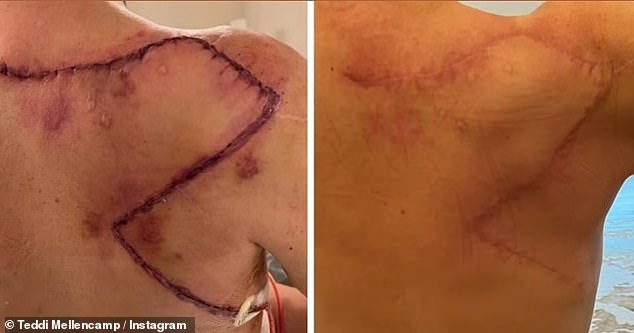 In a post on Instagram, she shared an update on her surgery scar and shared news from her three-month check-up