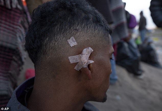 A migrant shows an injury he claimed he sustained after a Texas National Guard forced him back south of the barrier set up by the Texas National Guard on the Rio Grande in El Paso, Texas