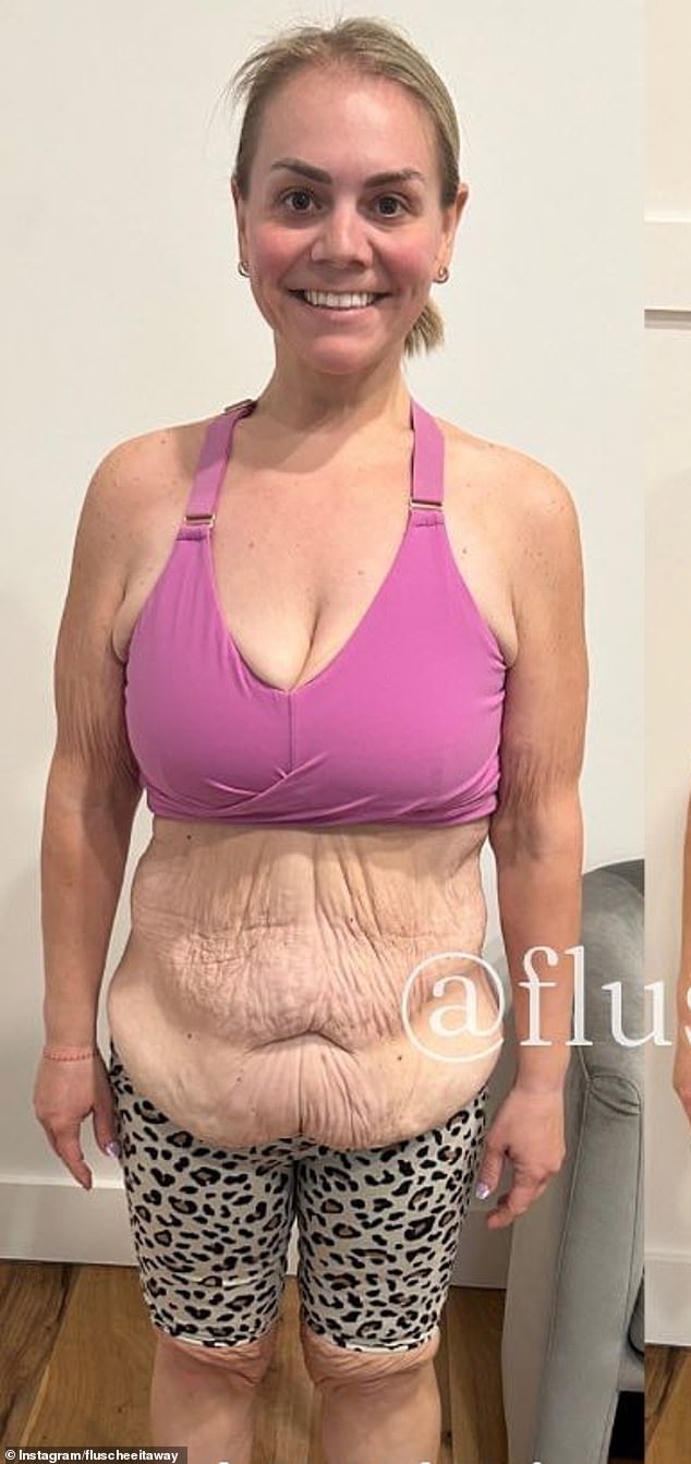 She lost 270 pounds and has lifted the lid on the realities of dealing with loose skin after undergoing four surgeries (after her first) to get rid of the sagging flaps across her body