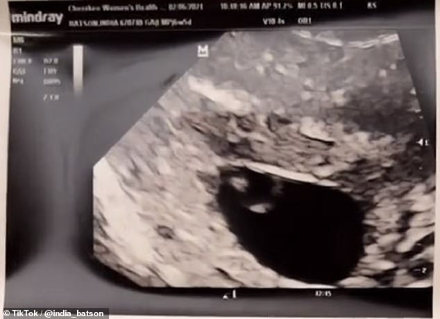 She made the request so that people like her won't be surrounded by visibly pregnant women happy with their ultrasound photos. Here you see a still image of her older pregnancy.