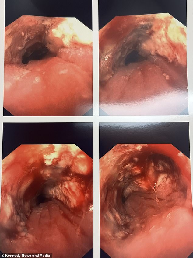 Acid leaking from batteries begins to burn through the esophagus just 30 minutes after being ingested, causing lifelong injuries and, in some cases, even death (pictured: Hospital scans reveal burns in Rosantina's throat)