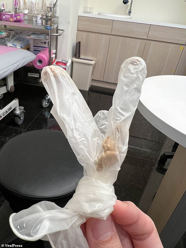 The medical professional pulled back the man's foreskin and gazed at the disgusting buildup of sickly yellow-brown smegma, seen here inside a medical glove.
