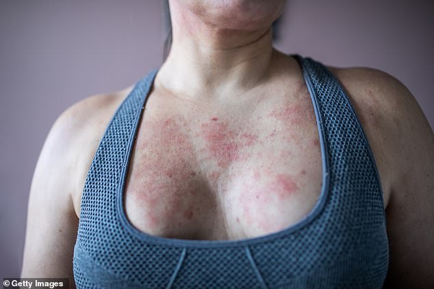 Eczema skin breakouts often appear red and scaly. These outbreaks can range from itchy to painful