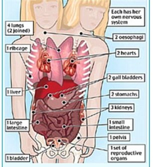 The couple share a single body and, from the waist down, share all their organs, including the intestine, bladder and reproductive organs.