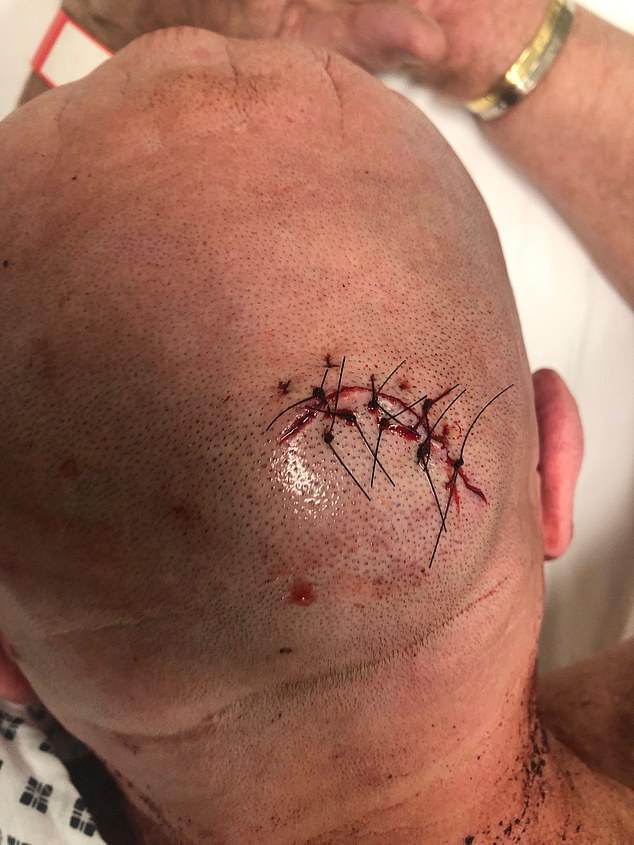 Stitches on the head wound suffered by security guard Mr. Simmons during the hammer raid.