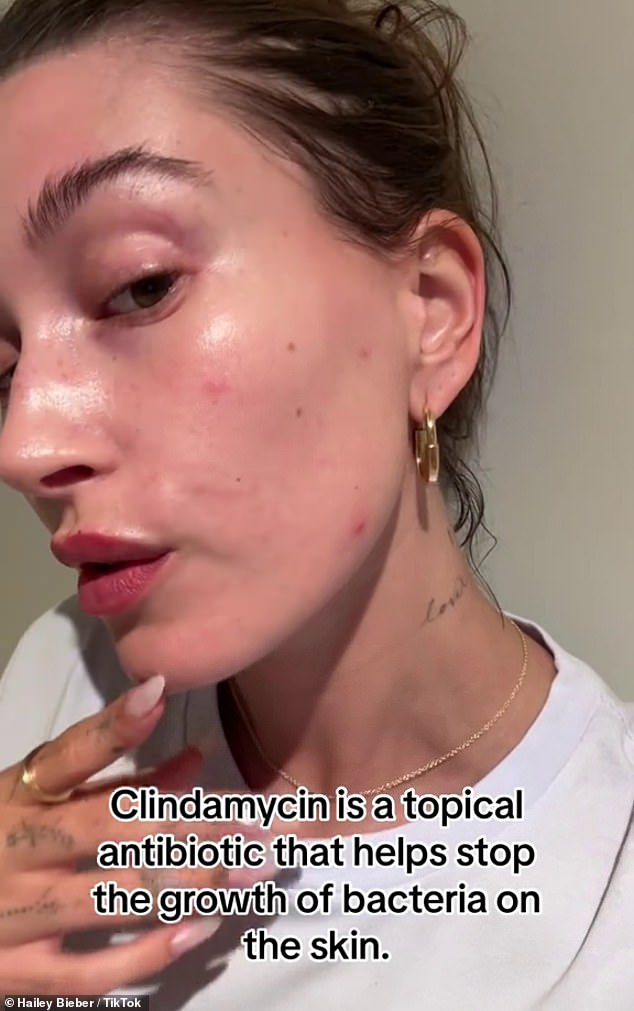 The model said she treats breakouts with two prescriptions: azelaic acid cream at night and clindamycin during the day.  She also uses Rhode Skin Glazing Milk and an SPF.