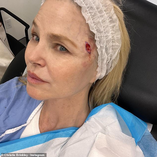 She also shared graphic images of the scar on her face after the cancer was removed - as she urged fans to check their bodies regularly for any abnormalities