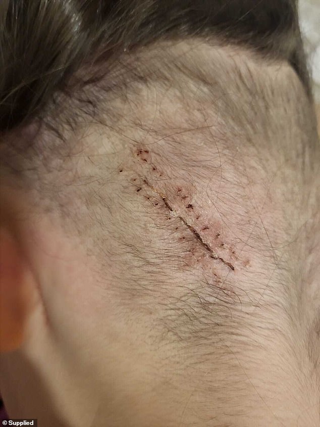 Pictured are Evie Whipps' scars after brain surgery