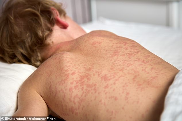 NSW Health has issued an urgent warning to residents in western Sydney after a woman was diagnosed with the highly infectious disease measles (pictured).