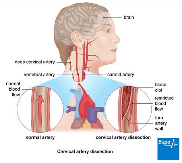 The tear allows blood to enter between the layers of the artery wall and separate them. This causes the artery wall to bulge, which can slow or stop blood flow to the brain. This can lead to a transient ischemic attack (TIA) or stroke
