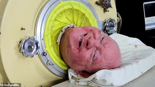 Paul Alexander has died aged 78 after an extraordinary life in an iron lung