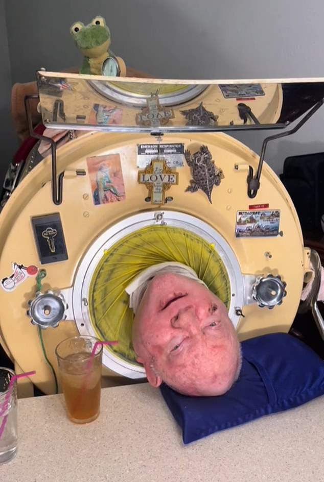 Paul Alexander, who lived in an iron lung for more than 70 years after polio left him paralyzed, reportedly died after contracting Covid-19