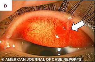 The dog bite caused blood vessels in the patient's eyes to burst, leading to bleeding