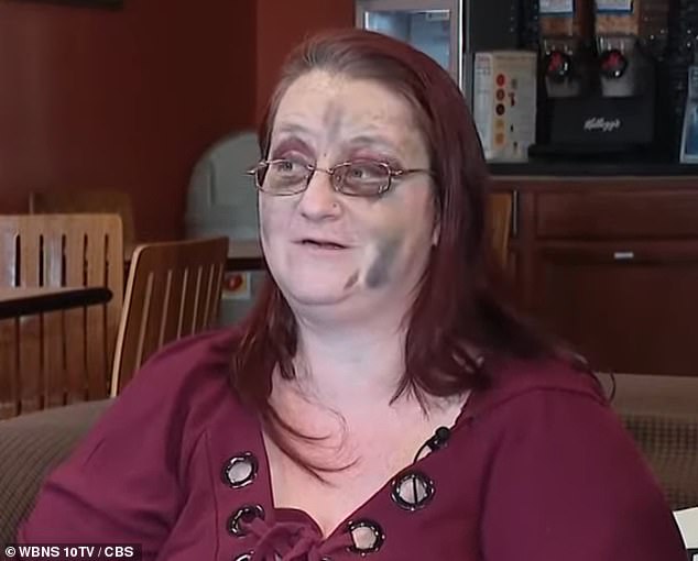 An Ohio mother has revealed the horrific bruises she suffered when a killer tornado ripped through her home.
