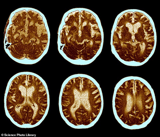 MRIs performed over 100 years showed that brain size has increased by 6.6 percent and could reduce the risk of developing Alzheimer's in younger generations.