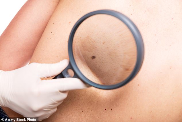Scientists have found a new way to detect any type of skin cancer in seconds.  (Stock image)