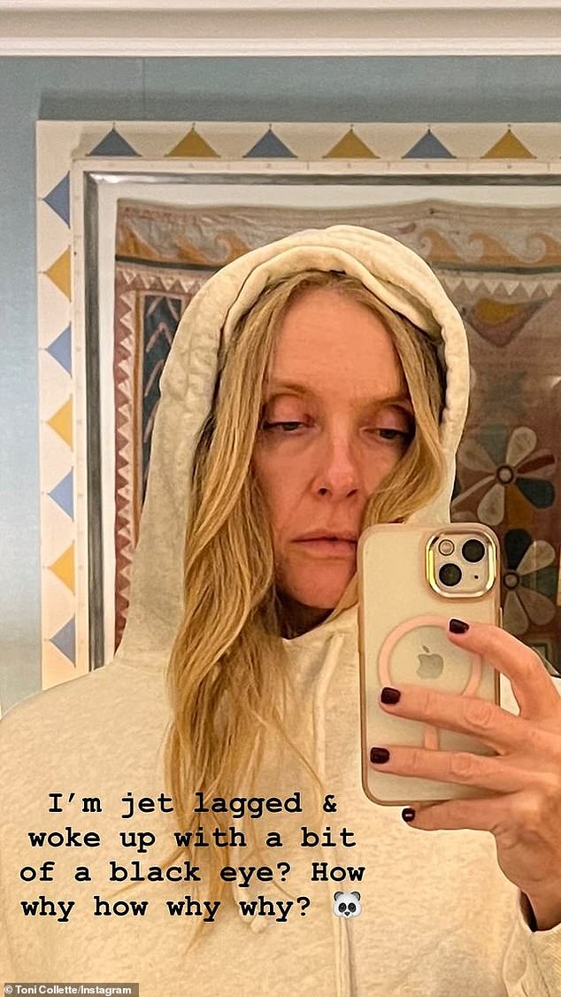 Toni Collette, 51, (pictured) woke up on Saturday looking unwell after discovering she had a black eye, after flying to Paris before filming her new comedy film A French Pursuit.