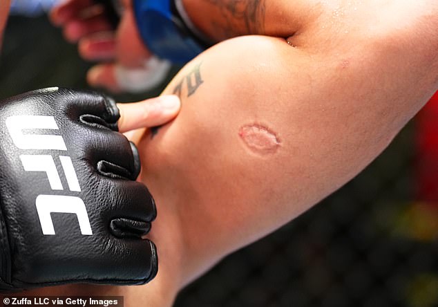 Lima shows off gruesome bite mark he suffered during flyweight fight in Las Vegas