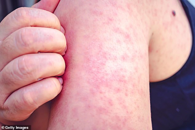 Measles usually starts with cold-like symptoms, before causing a rash made up of small red dots, some of which may feel slightly raised. According to the NHS, it usually starts on the face and behind the ears before spreading further.
