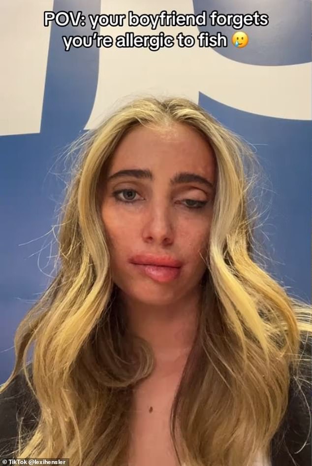 Lexi Hensler, who lives in California, took to TikTok to candidly reveal her swollen features after accidentally eating seafood.