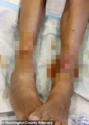 A boy seen with infected cuts on his legs
