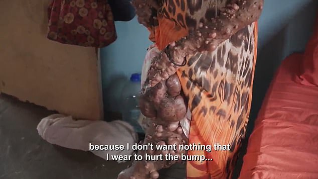 The 42-year-old woman has to wear loose clothing to cover her large tumors.