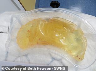 The Department of Health has long said there was no evidence to suggest ruptured PIP implants were toxic and it did not believe they were a threat to women's long-term health. Pictured is Ms Hewson's broken PIP implant