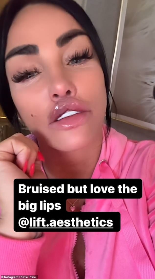 Katie, who last visited the salon to get her lips done on March 8, showed off her 'extra, extra, extra big' lips in a heavily leaked Instagram video.