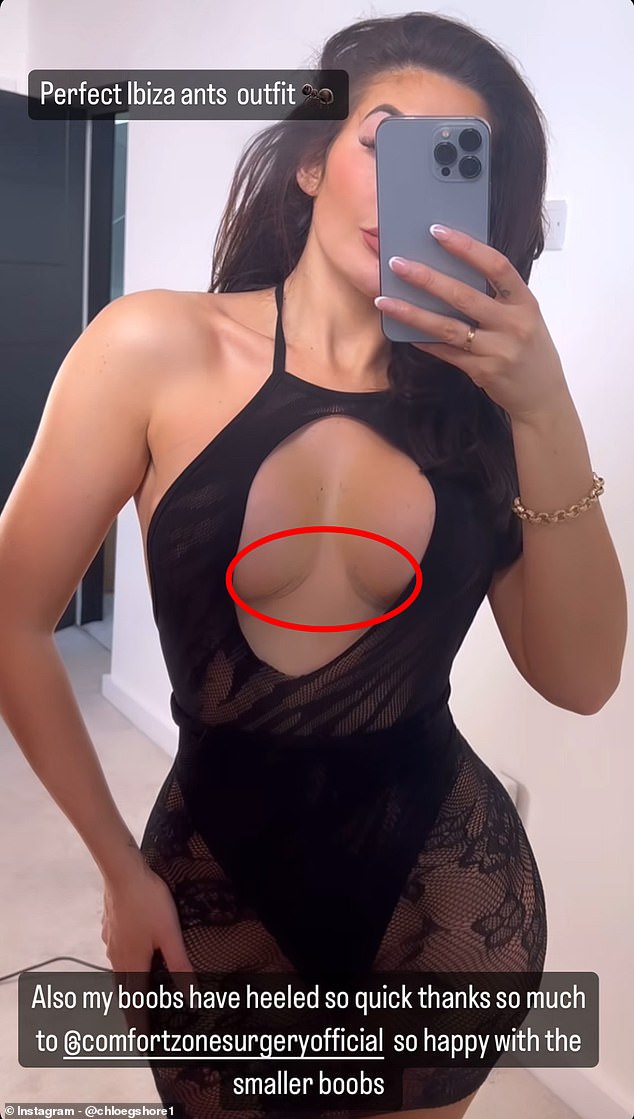 Chloe Ferry, 28, proudly showed off the scars from her corrective boob job on Instagram in a daring dress that had a cut-out section.
