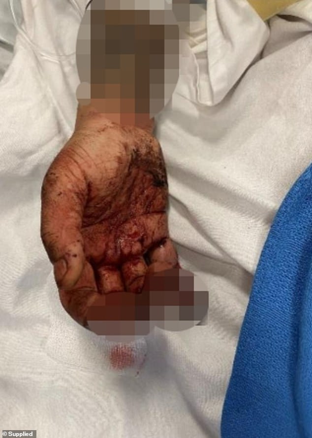 The hand of one of the male friends whose fingers were allegedly amputated in the horrific experience.