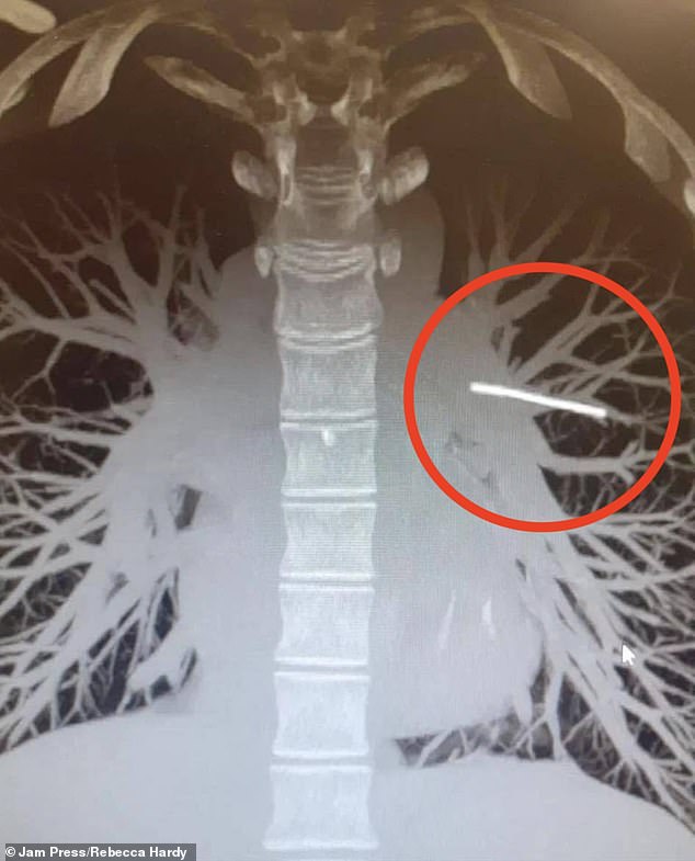 When doctors located the implant after a CT scan, it was in one of his pulmonary arteries, blood vessels that carry oxygenated blood from the heart to the lungs.