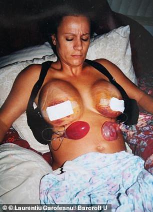Ms Wildd after surgery with a breast size of 800 CC in 2001