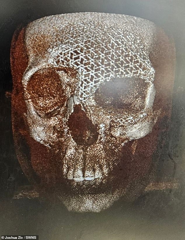 An x-ray of Mr. Ziv's face. Once airlifted to a hospital in Turin, it was discovered that Ziv had broken almost every bone in his face except his jaw.