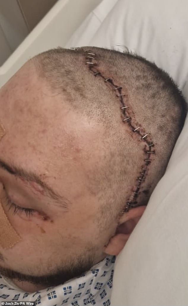 Ziv underwent a 12-hour surgery to install titanium plates in his face and skull to reconstruct it, leaving him with a huge scar from ear to ear.
