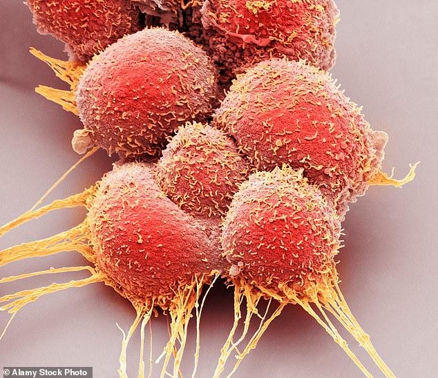 Prostate cancer claims 12,000 lives a year, making it the second deadliest cancer in men in the UK (archive image of prostate cancer cells)