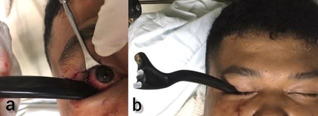 Stomach-churning images show the mango embedded in the right eye socket of an unidentified 19-year-old.  It is believed firefighters had to cut the bike's brake lever at the scene of the accident.