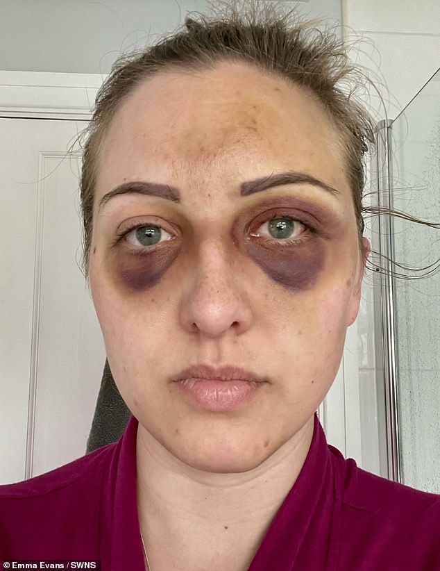 Photographs taken after Emma's seizure show her with purple bruises under her eyes after blood vessels in her face burst.
