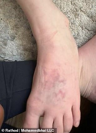 A boy suffered bruises on his feet