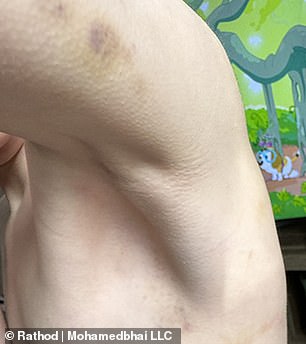 The bruised arm of an autistic child