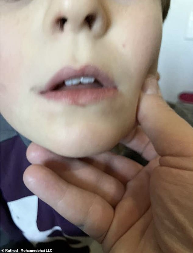 In photographs released by the family's lawyer, the autistic boy had severe bruising on his feet after the March 18 incident, but further evidence shows he suffered cuts to his lips and bruises to his neck two months earlier.