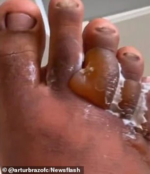Their toes became swollen