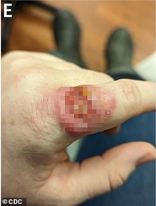 The infection caused horrible sores to appear on the vet tech's finger and spread up her arm.