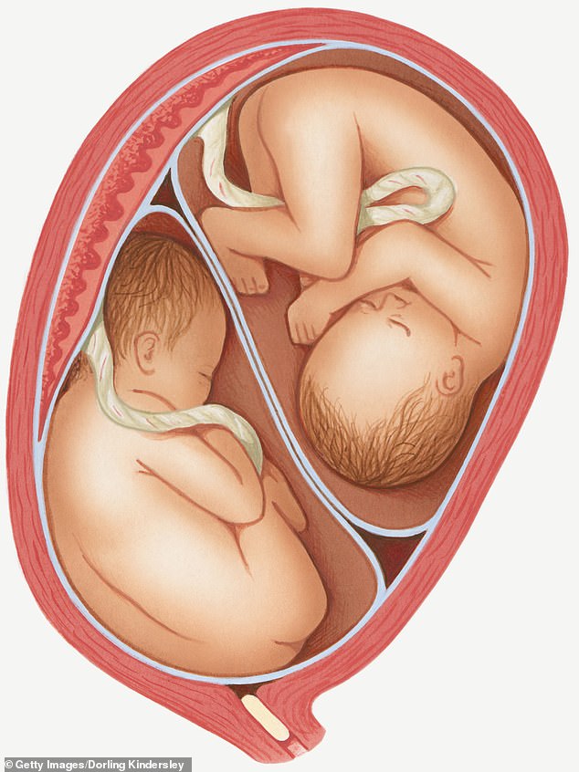 In utero, the male sex hormone testosterone has been shown to sometimes affect twins.