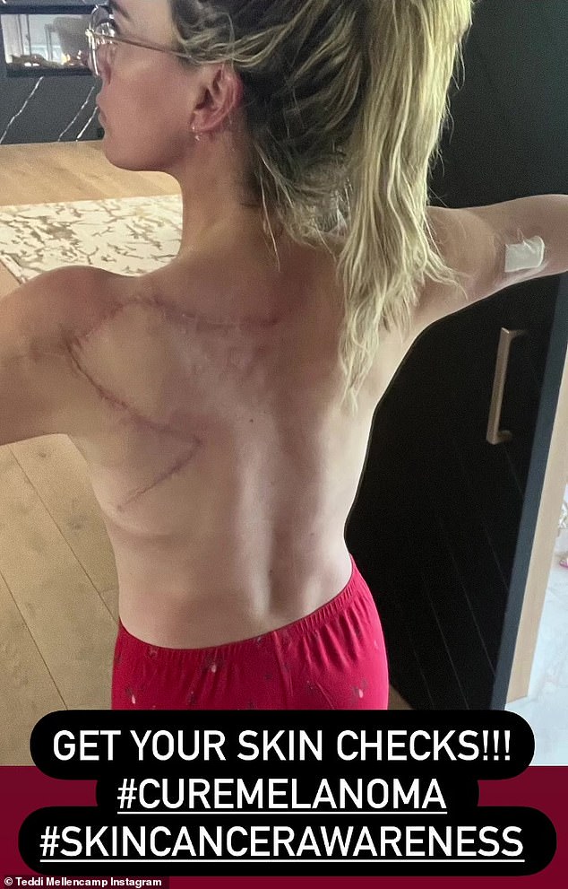 The 42-year-old reality star, daughter of legendary singer-songwriter John Mellencamp, gave her followers an update on her ongoing battle with skin cancer.