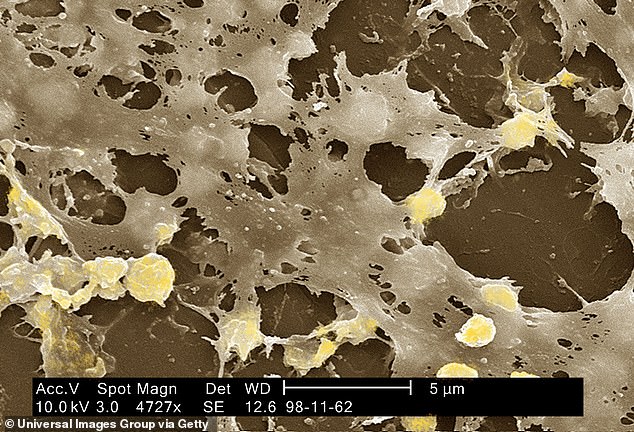 MRSA, a drug-resistant bacteria, under the microscope. Although skin infections with this bacteria can often be treated, if it enters the bloodstream, it can cause septic infection and death.